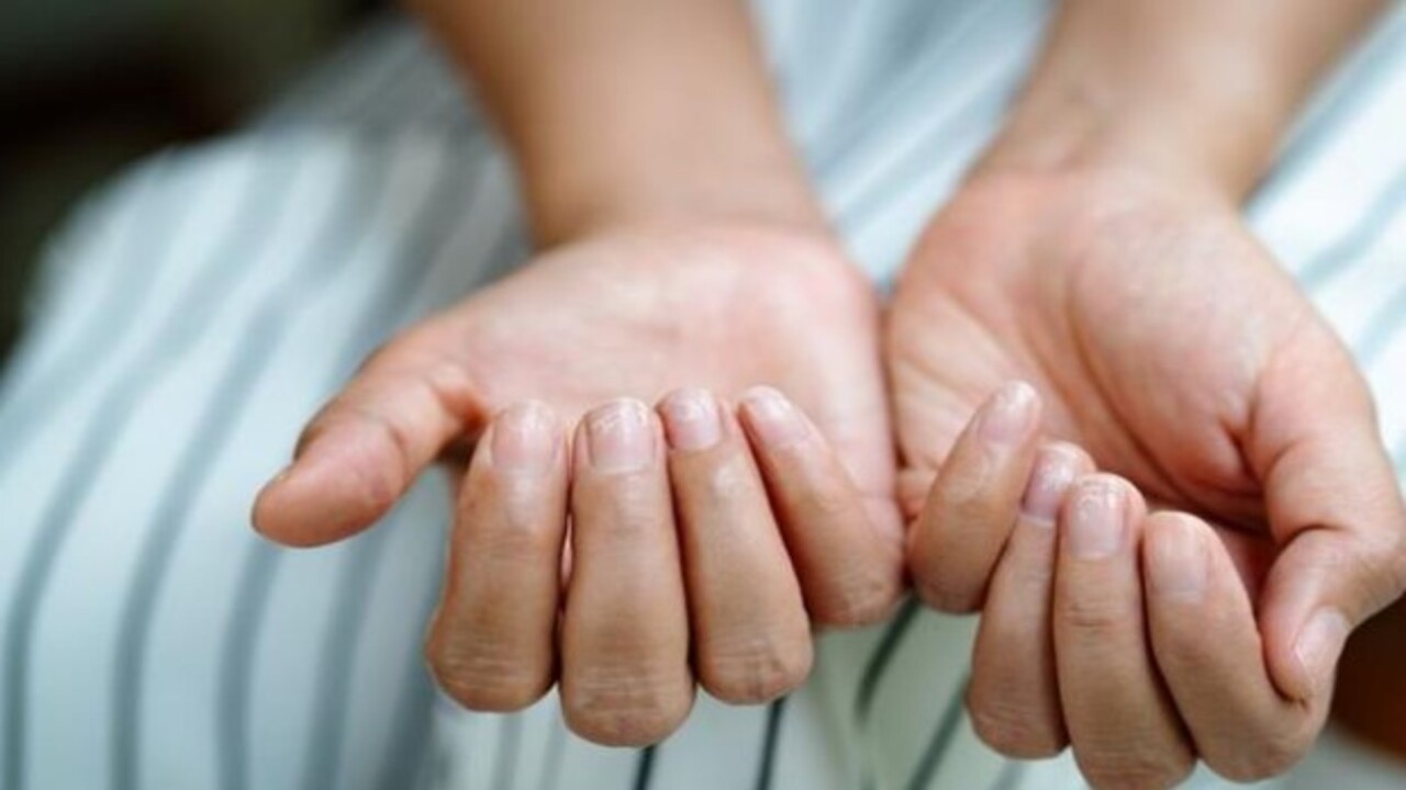 Foto - Bu hastalığın habercisiymiş! Tırnağınızda beyaz lekeler varsa dikkat