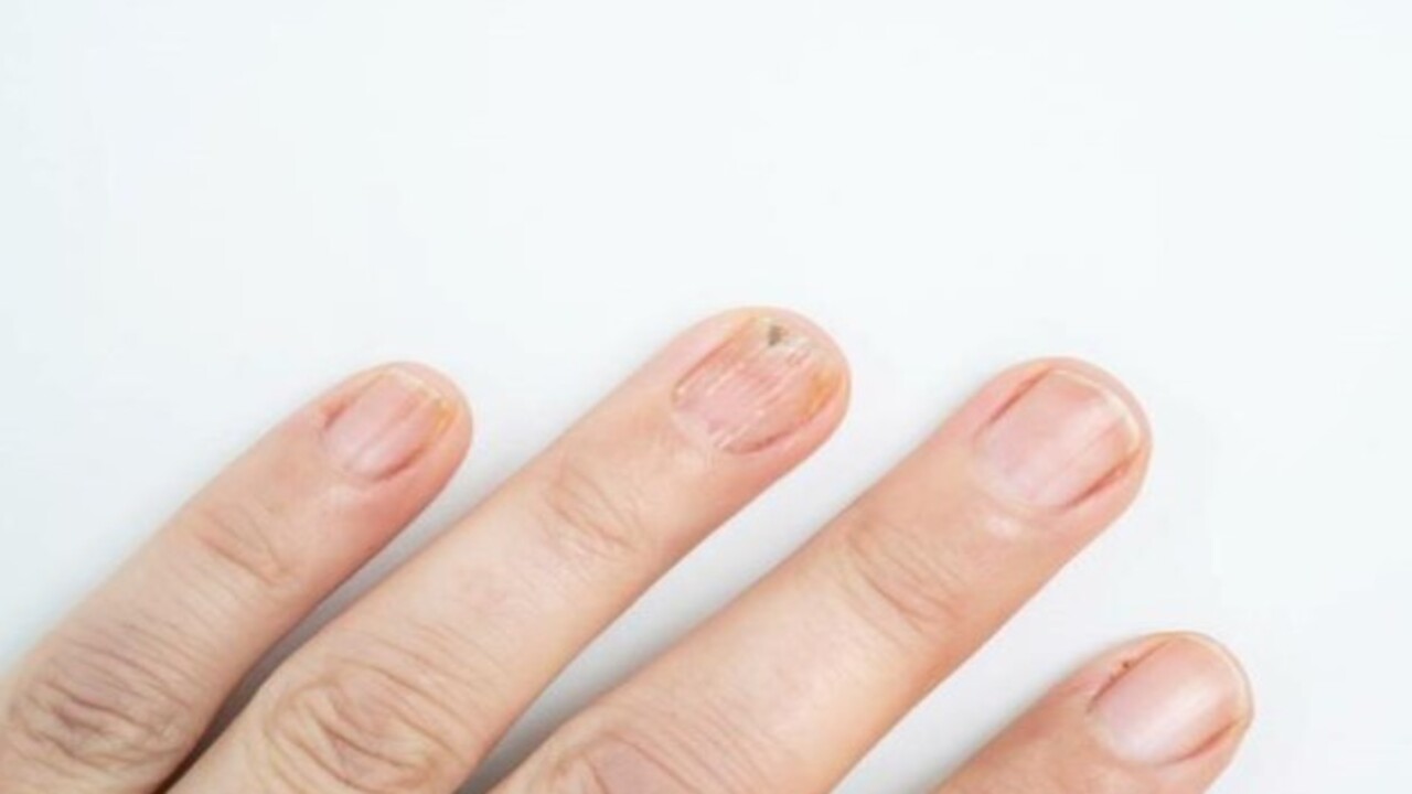 Foto - Bu hastalığın habercisiymiş! Tırnağınızda beyaz lekeler varsa dikkat