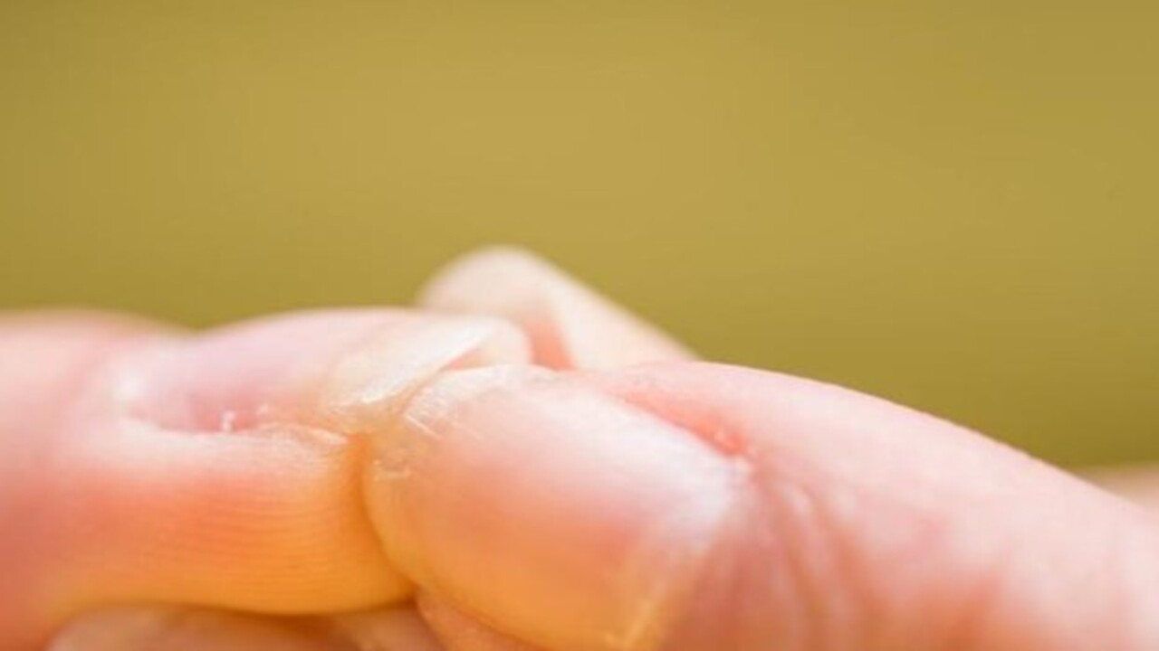 Foto - Bu hastalığın habercisiymiş! Tırnağınızda beyaz lekeler varsa dikkat