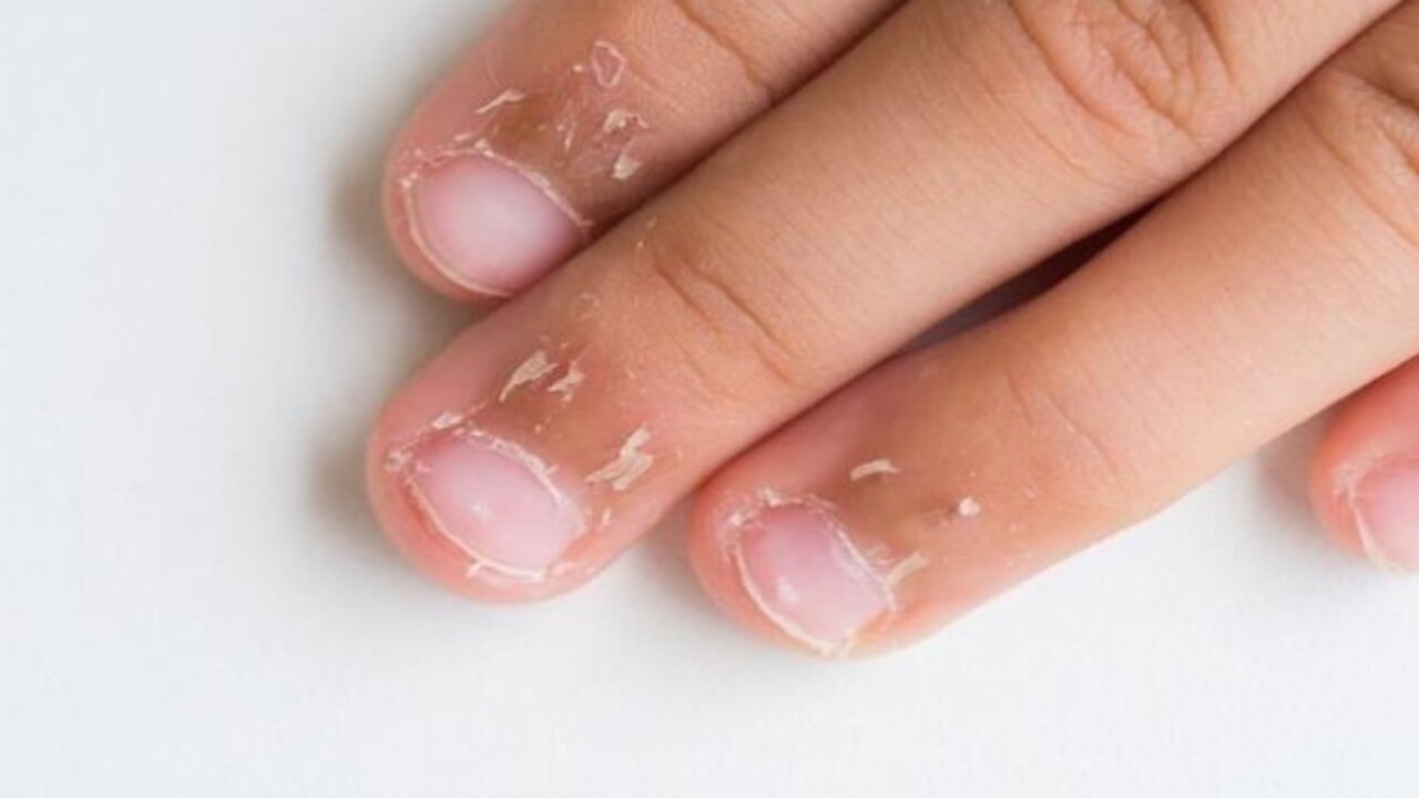 Foto - Bu hastalığın habercisiymiş! Tırnağınızda beyaz lekeler varsa dikkat