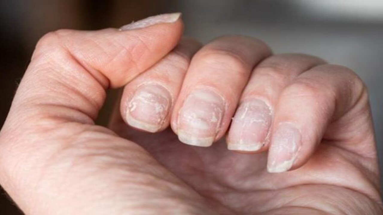 Foto - Bu hastalığın habercisiymiş! Tırnağınızda beyaz lekeler varsa dikkat