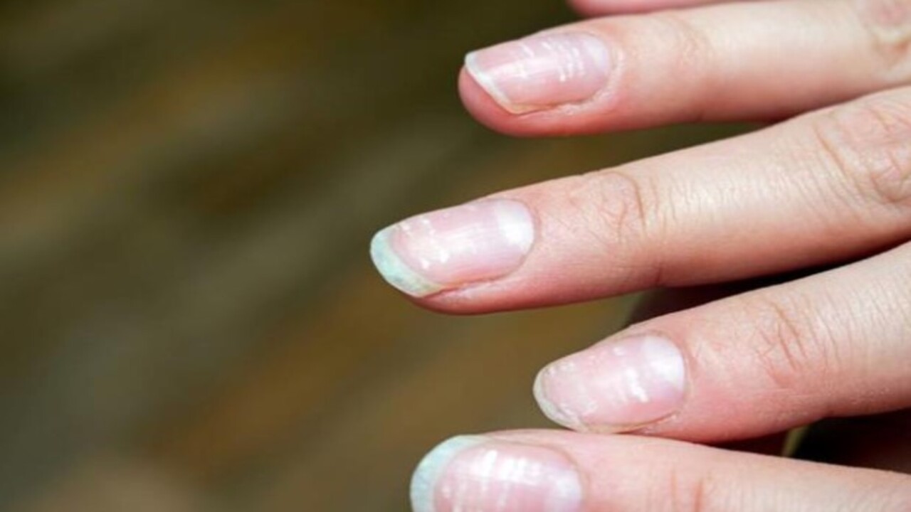 Foto - Bu hastalığın habercisiymiş! Tırnağınızda beyaz lekeler varsa dikkat
