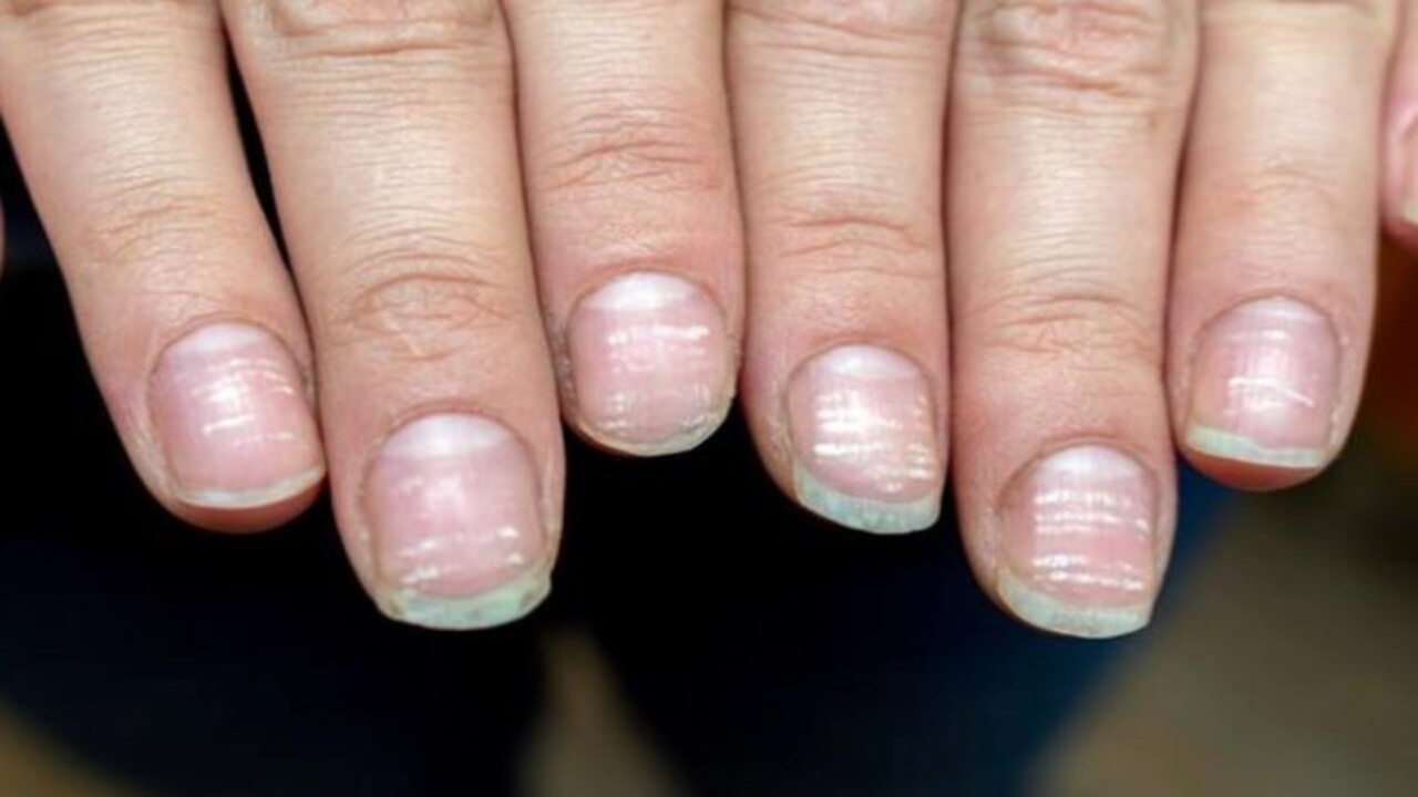 Bu hastalığın habercisiymiş! Tırnağınızda beyaz lekeler varsa dikkat