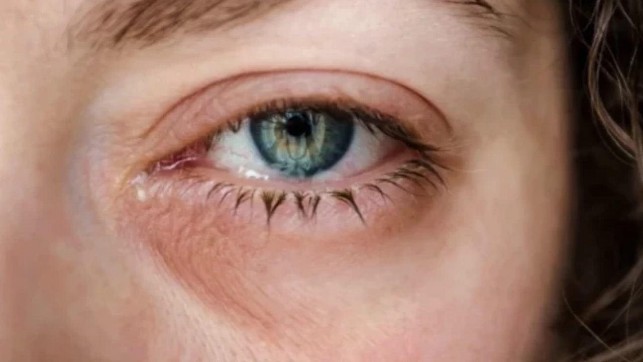 Herkes yorgunluk deyip geçiyor: Gözlerde kalıcı hasara neden olabilir!