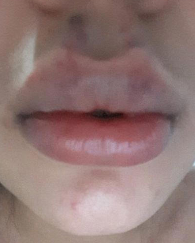 Foto - Bu kadar kolaymış deyip göze alıp yapanlar! Estetik uyarısı: Bakın vücudunuzda neler oluyor?