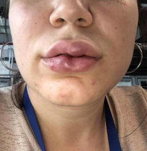 Foto - Bu kadar kolaymış deyip göze alıp yapanlar! Estetik uyarısı: Bakın vücudunuzda neler oluyor?