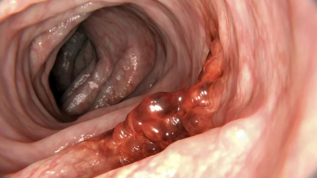 Foto - Bu kanser türü aylar öncesinden geliyorum diyor! İşte gizli 5 belirtisi buymuş