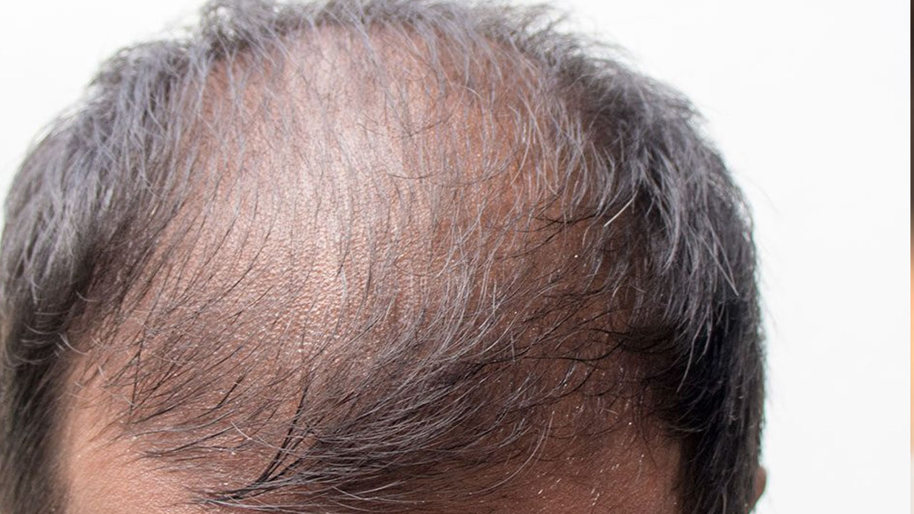 Foto - Bu karışım sayesinde saçınız artık hiç beyazlamayacak! Ünlü ilaçlara rakip oluyor!