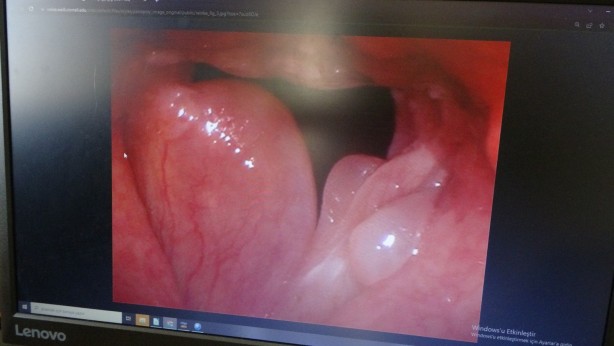 Foto - Bu sorun sizde de olabilir Sesiniz giderek kısılıyorsa dikkat!