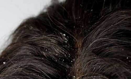 Foto - Bu yöntem, kepeği bıçak gibi kesiyor! Bunu deneyen, Canan Karatay’a sabah akşam dua edecek