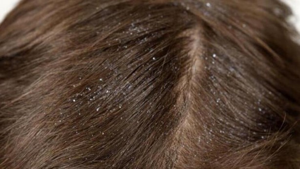 Foto - Bu yöntem, kepeği bıçak gibi kesiyor! Bunu deneyen, Canan Karatay’a sabah akşam dua edecek