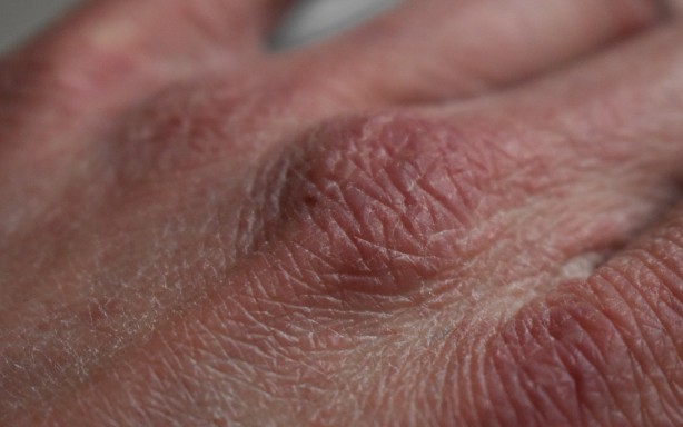 Foto - C vitamini eksikliğinin 9 önemli belirtisi