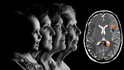 Foto - Çağımızın vebası Alzheimer’dan korunmak için mutlaka tüketin! İşte hayatınızı değiştirecek o 3 besin