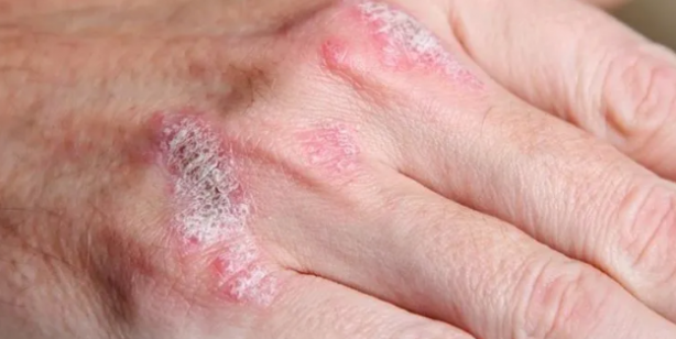 Foto - Canan Karatay 30 günde tüm sorunları giderecek yöntemi açıkladı: Kaşıntı, egzama, ürtiker, sedef bu sebeple ortaya çıkıyor!