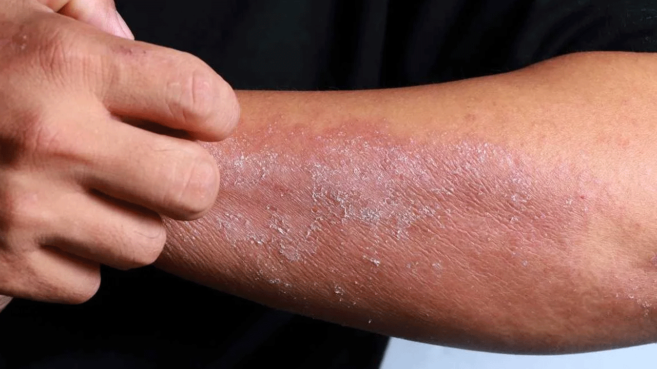 Foto - Canan Karatay'dan uyarı: Egzaması olan sakın bunu yapmasın!