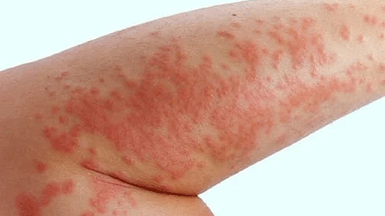 Foto - Canan Karatay'dan uyarı: Egzaması olan sakın bunu yapmasın!