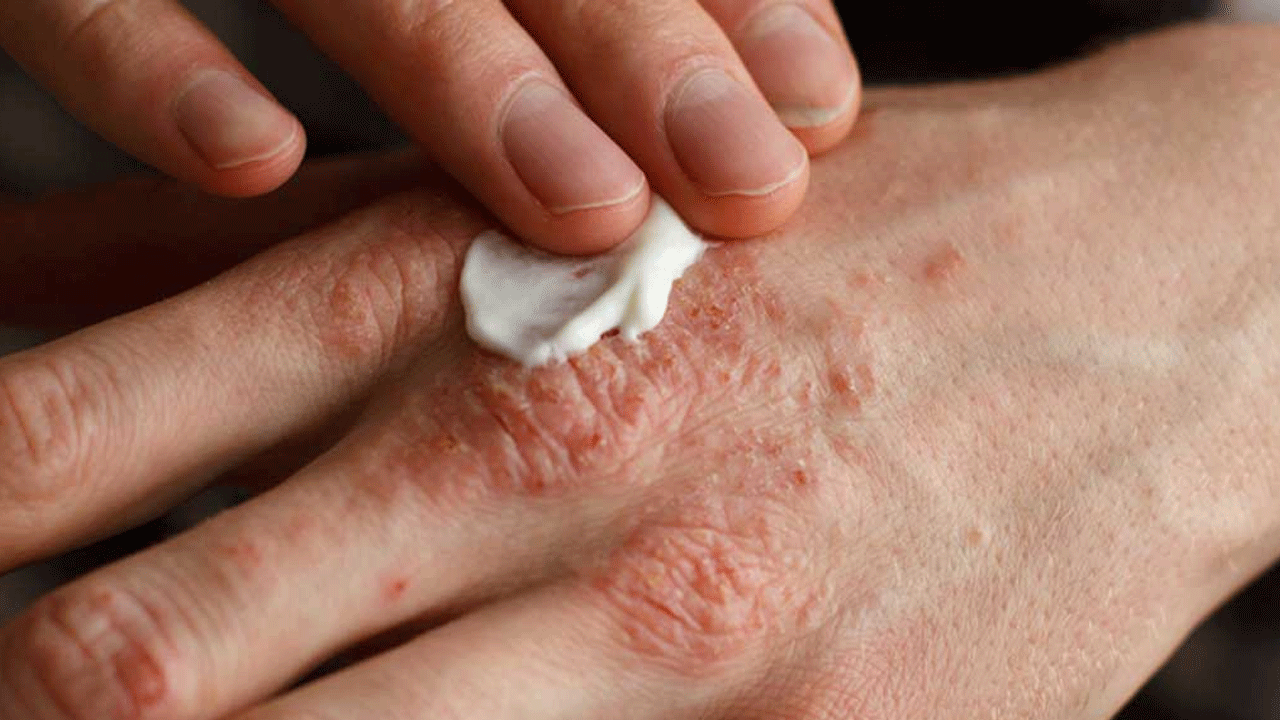 Foto - Canan Karatay'dan uyarı: Egzaması olan sakın bunu yapmasın!