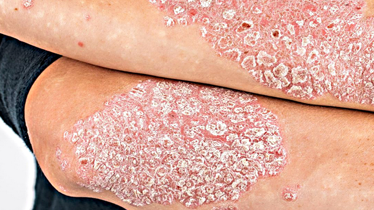 Foto - Canan Karatay'ın egzama uyarısı! Temizlikte çamaşır suyu mu sirke mi etkili? Bir ilk olacak açıklama…