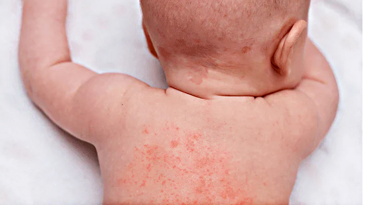 Foto - Canan Karatay'ın egzama uyarısı! Temizlikte çamaşır suyu mu sirke mi etkili? Bir ilk olacak açıklama…