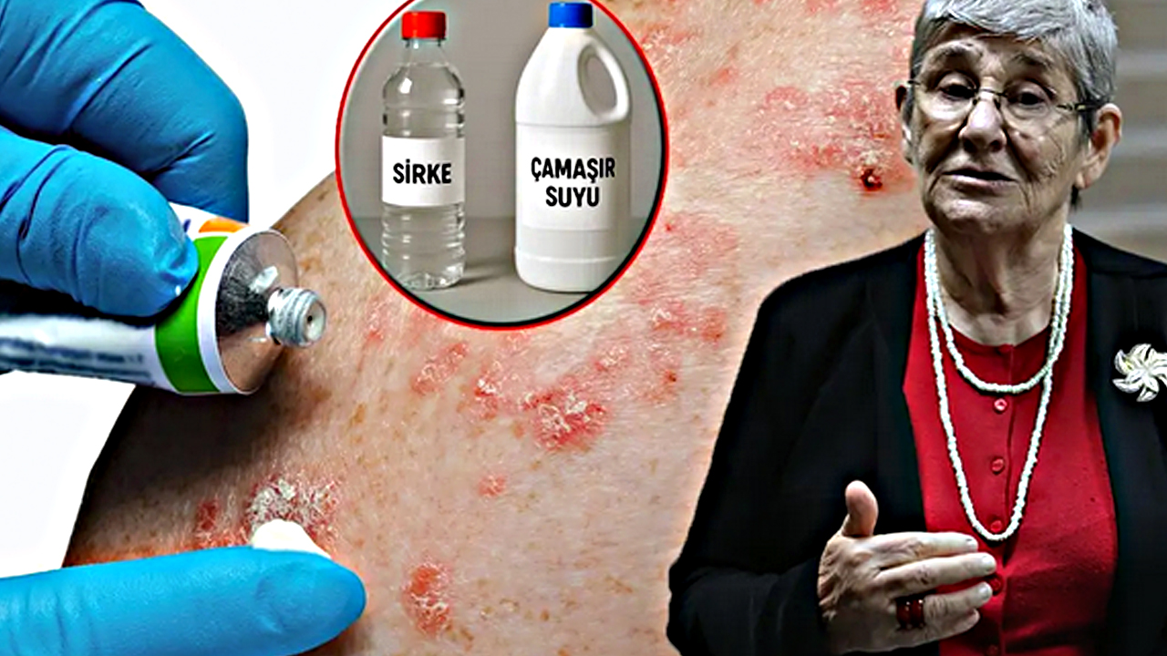 Foto - Canan Karatay'ın egzama uyarısı! Temizlikte çamaşır suyu mu sirke mi etkili? Bir ilk olacak açıklama…