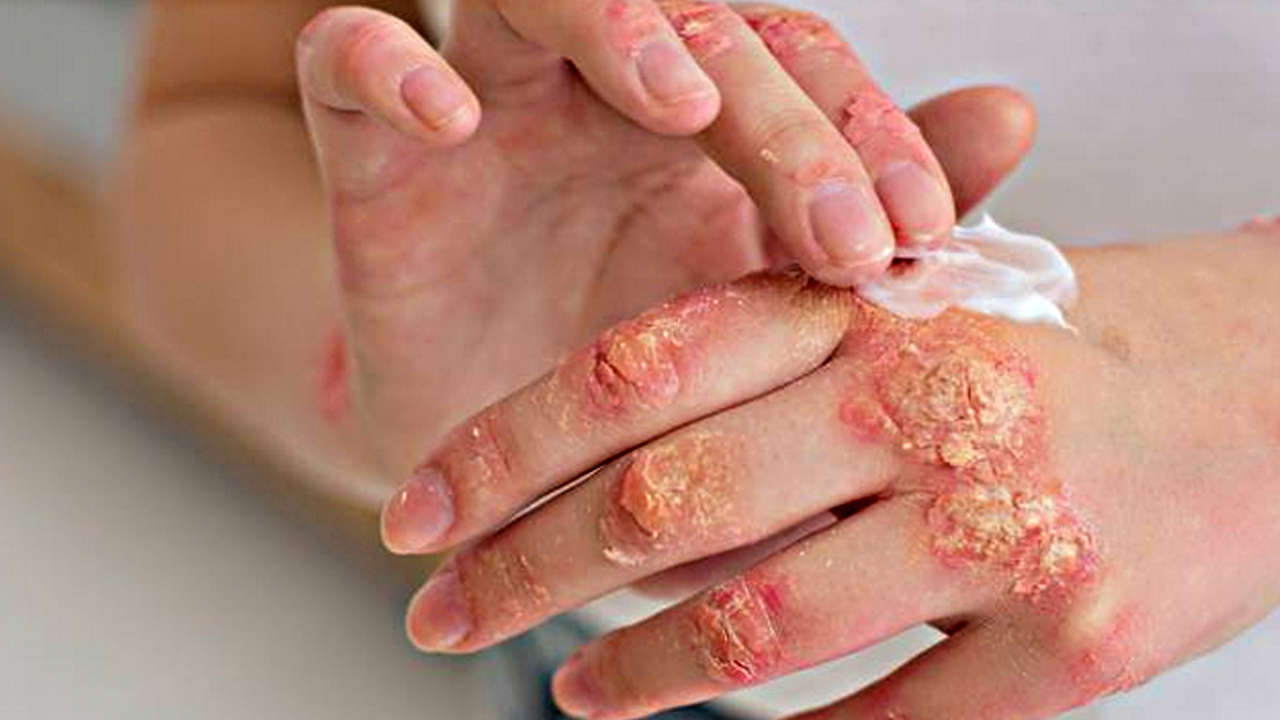 Foto - Canan Karatay'ın egzama uyarısı! Temizlikte çamaşır suyu mu sirke mi etkili? Bir ilk olacak açıklama…