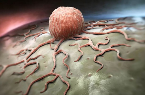 Foto - Çarpıcı kanser kanser araştırması! Vakaların yüzde 40'ı hızla yayılan sorunla ilgili