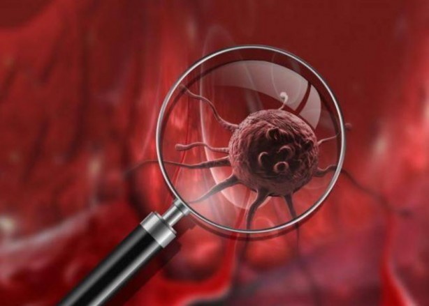 Foto - Çarpıcı kanser kanser araştırması! Vakaların yüzde 40'ı hızla yayılan sorunla ilgili