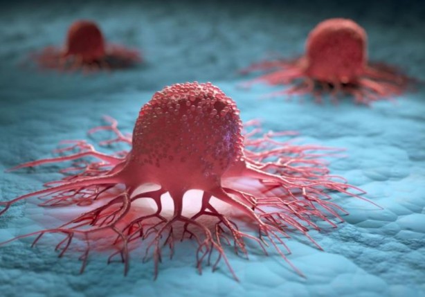 Foto - Çarpıcı kanser kanser araştırması! Vakaların yüzde 40'ı hızla yayılan sorunla ilgili