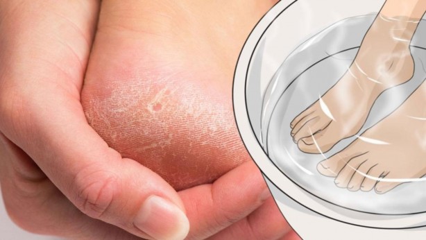 Çatlamış topukları anında iyileştiriyor! Tırtıklı ayak tabanını pamuk gibi yumuşacık yapan doğal yöntemler