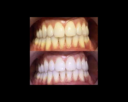 Foto - Ceviz kabuğunu sakın atmayın! İnanılmaz bir etkisi var... Hiçbir uzmanın bahsetmediği harika bilgi...