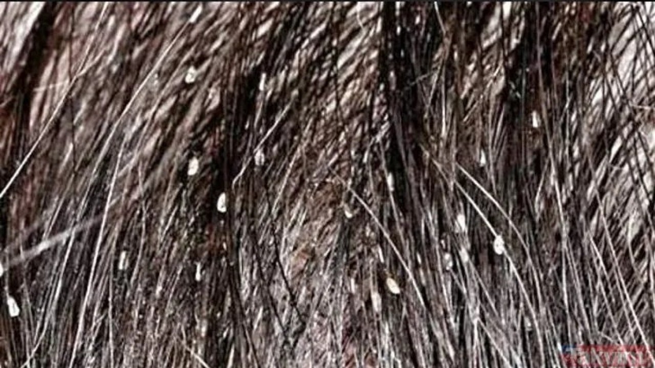 Foto - CHP yüzünden susuzluktan bitlenen İzmir halkı ne yapmalı? Bite karşı mücizevi bitkisel çözüm