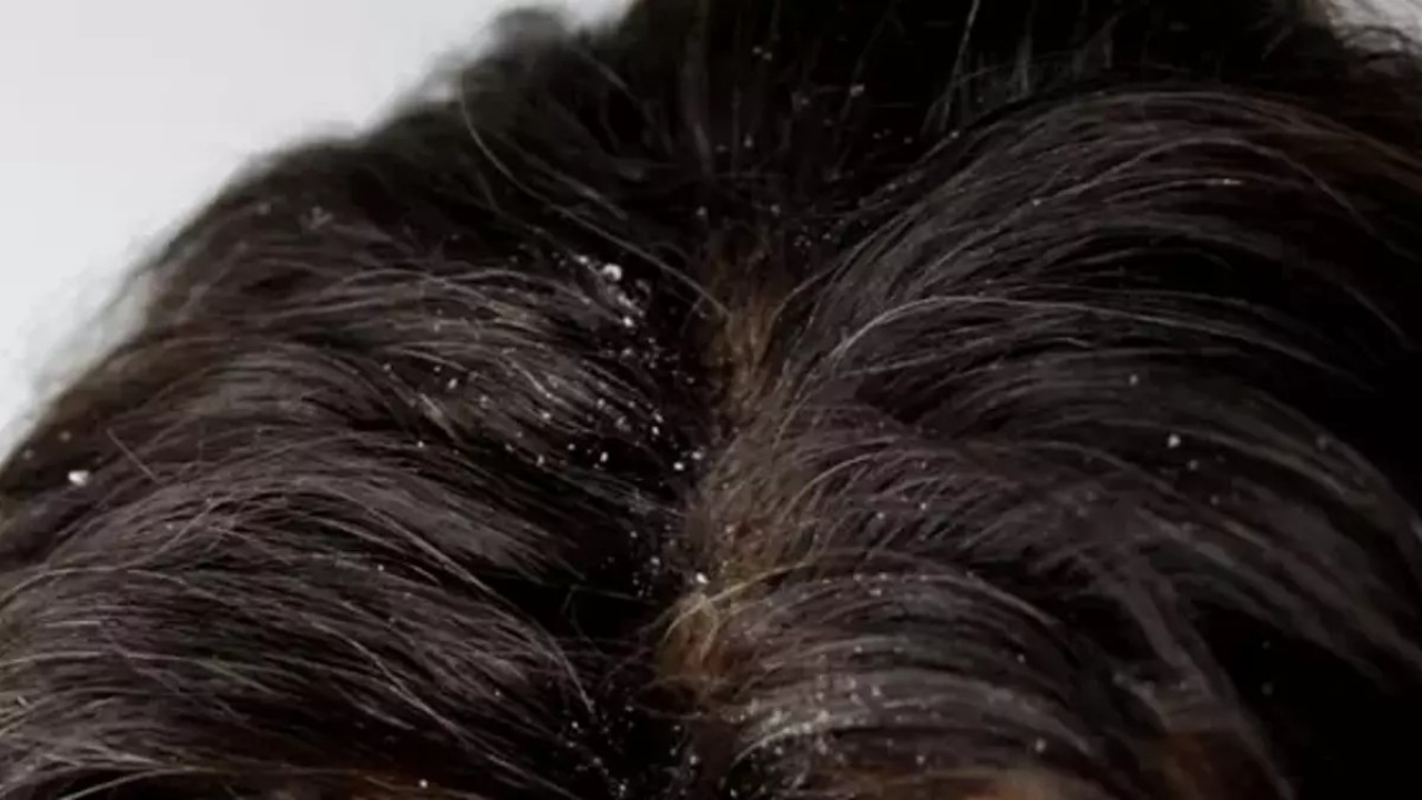 Foto - CHP yüzünden susuzluktan bitlenen İzmir halkı ne yapmalı? Bite karşı mücizevi bitkisel çözüm