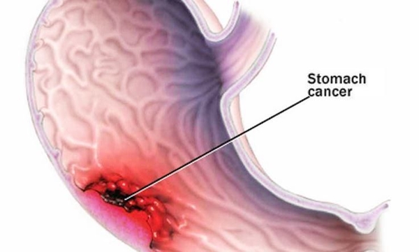 Foto - Çiğ et mide kanserine sebep oluyor