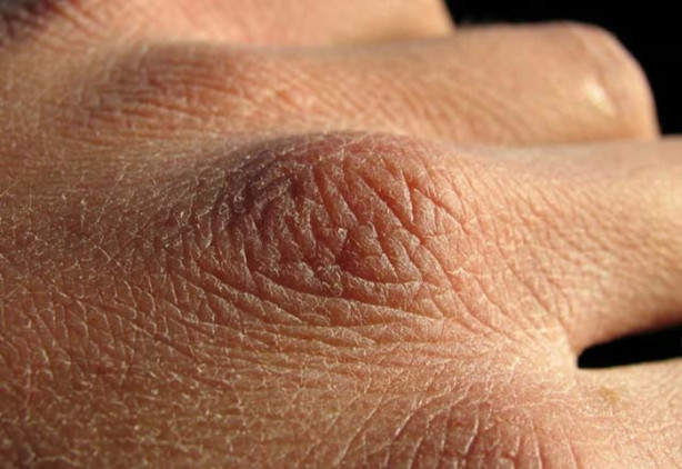 Foto - Cildiniz böyleyse dikkat!