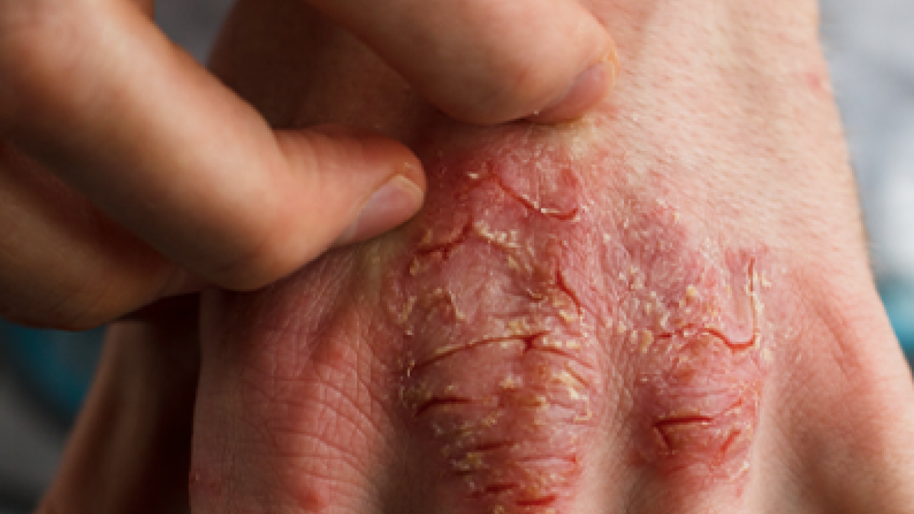 Cilt kuruyor! Kış aylarında egzama ile savaşmanın en etkili 7 yolu...