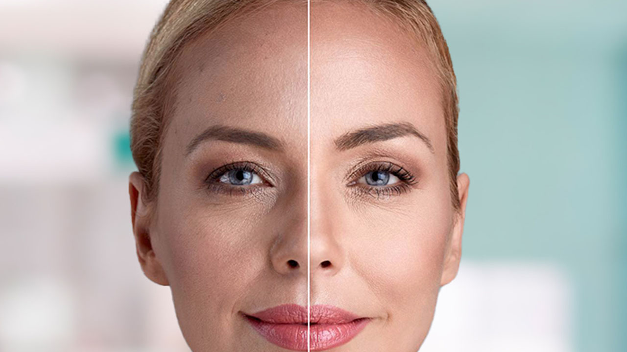 Foto - Ciltte oluşan lekelere son!