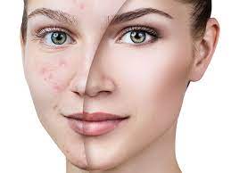 Foto - Ciltteki kahverengi lekeleri yok eden 10 doğal kür: Elinde yapıyorlar! Bu detayı kimse bilmiyor