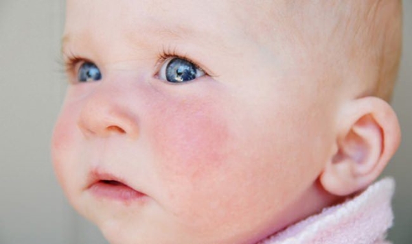 Foto - Çocuğunuz aşırı terliyorsa...