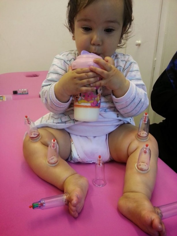 Foto - Çocuklara hacamat yaptırılabilir mi?