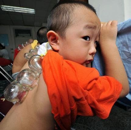 Foto - Çocuklara hacamat yaptırılabilir mi?