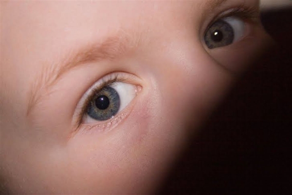 Foto - Çocuklarda vitamin eksikliğini anlamak çok kolay!