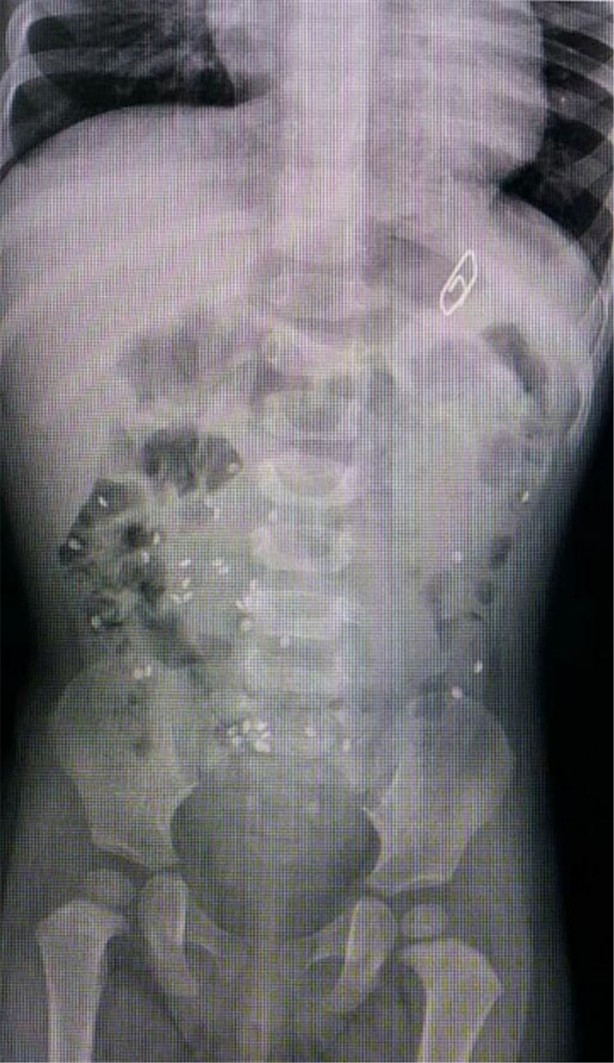 Foto - Çocukların midesinden öyle şeyler çıktı ki!