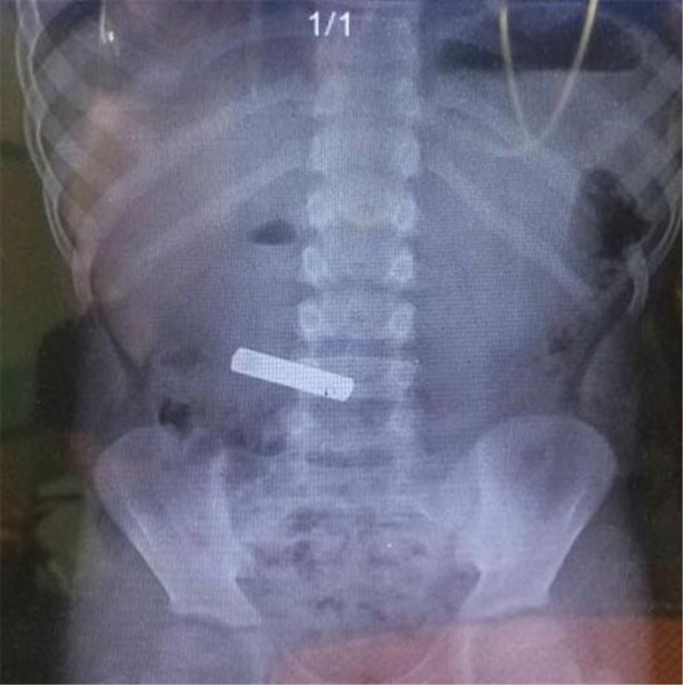 Foto - Çocukların midesinden öyle şeyler çıktı ki!