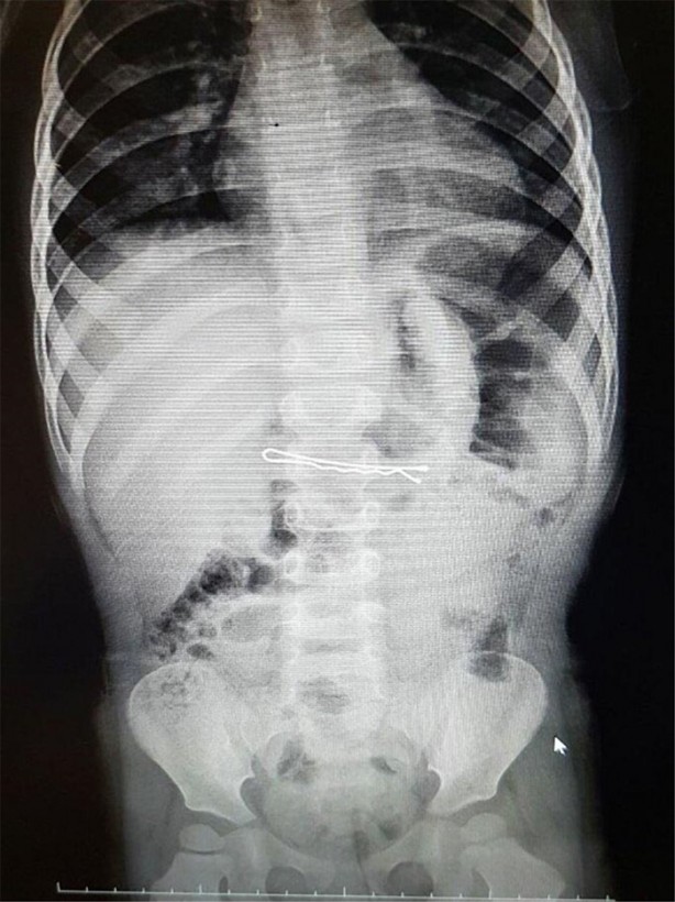 Foto - Çocukların midesinden öyle şeyler çıktı ki!