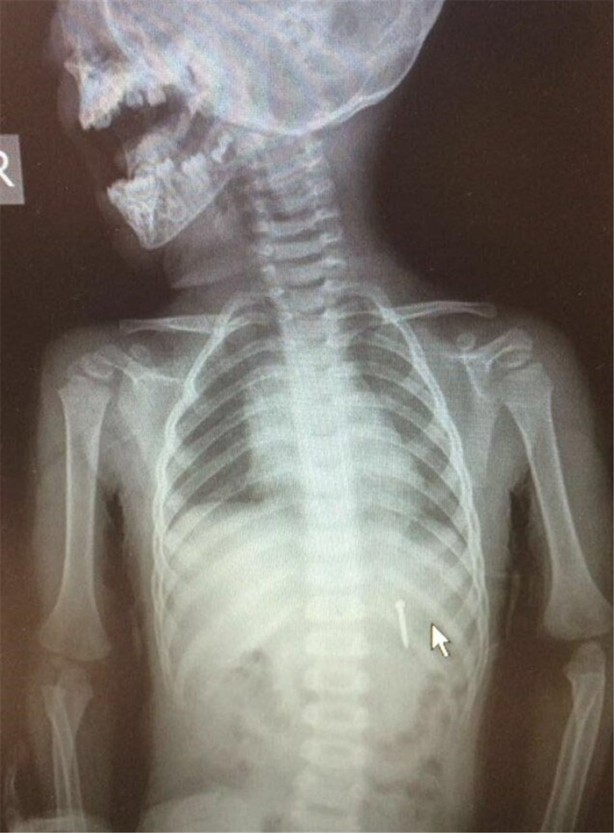 Foto - Çocukların midesinden öyle şeyler çıktı ki!