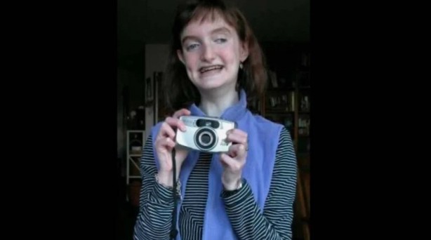 Foto - Çok nadir görülüyor! Tıp dünyasının sıradışı 10 hastalığı