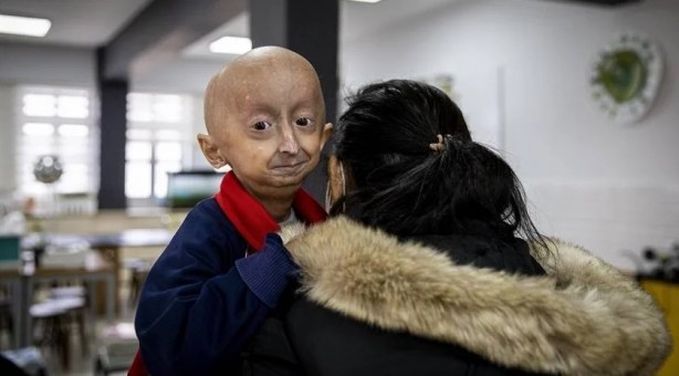 Foto - Çok nadir görülüyor! Tıp dünyasının sıradışı 10 hastalığı