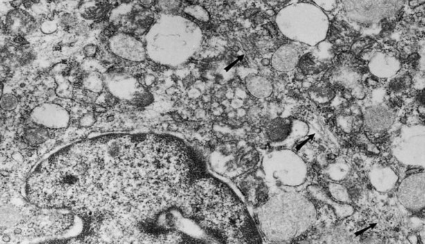 Foto - Çok nadir görülüyor! Tıp dünyasının sıradışı 10 hastalığı