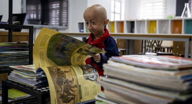 Foto - Çok nadir görülüyor! Tıp dünyasının sıradışı 10 hastalığı