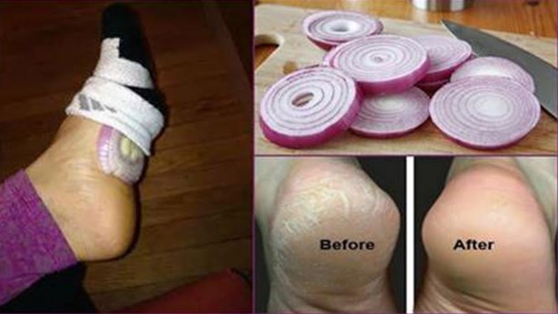 Foto - Çorabınızın için yarım soğan koyup sabaha kadar beklerseniz bakın ne olur? Herkes bunu yapıyor